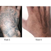รูปภาพถ่ายที่ Tattoo Removal Inc โดย Tattoo Removal Inc เมื่อ 2/22/2018
