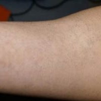 Tattoo Removal Atlanta Ga / On Demand Laser Tattoo Removal Atlanta Ga / Ink eraser is a laser tattoo removal clinic that strives to be accessible, which is why we offer financing options at our multiple locations in georgia: