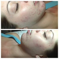 clear beauty acne clinic