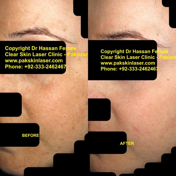 clear skin laser clinic