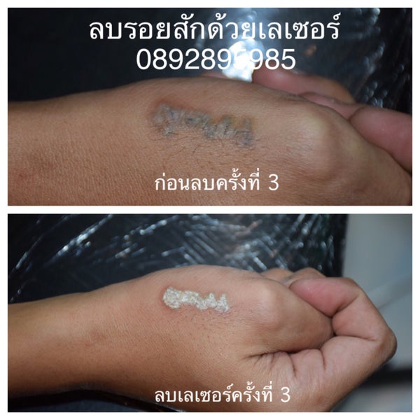Песня тату на теле ночи горели. Ремувер для тату фото результата. tattoo removal - laser radiation and tattooed skin.