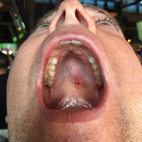 Swallowed a piece of glass managed to cut the top of my mouth. spoke to was the manager, said my tab will be taken care.Tab was processed.Left VM's to discuss this & have NEVER received callback..