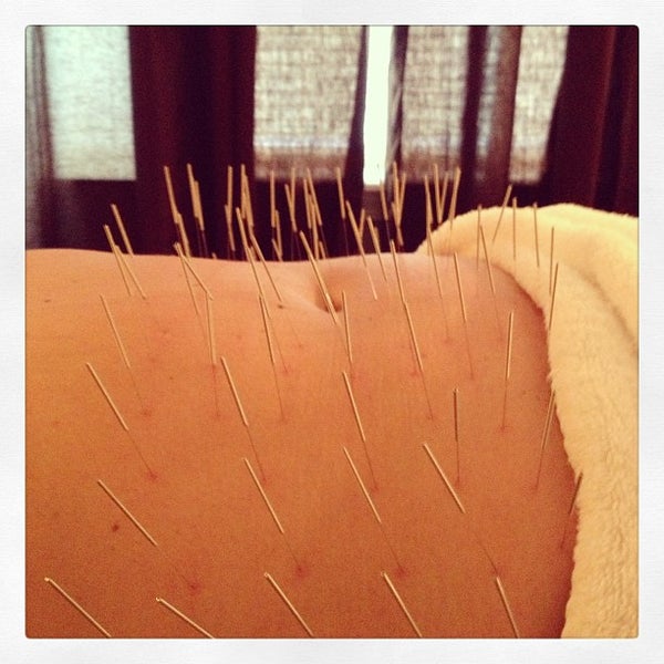 Healthpointe Jacksonville Acupuncture and Wellness Clinic Southeast Jacksonville 3 tips