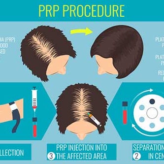 Prp Treatment For Hair Loss 3 Tips