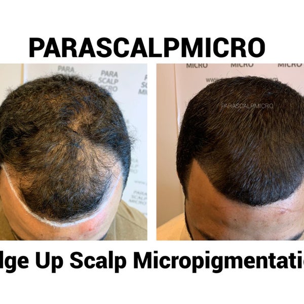 Photos At Parascalpmicro Paramedical Scalp Micropigmentation