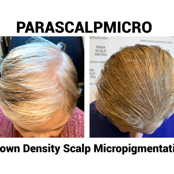 Photos At Parascalpmicro Paramedical Scalp Micropigmentation