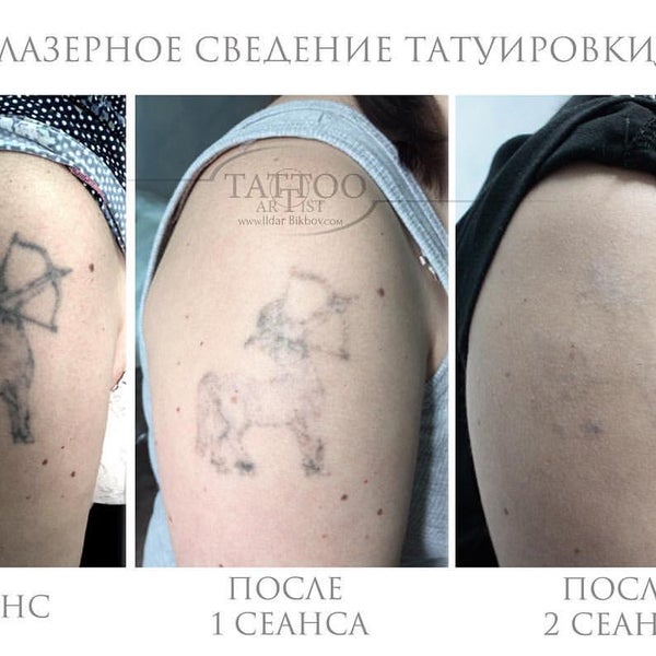 Удаление тату цена москва. Лазерное сведение татуировок. Сведение тату до и после.