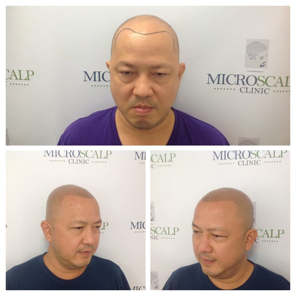 Photos At Micro Scalp Clinic Health Beauty Service In Boston