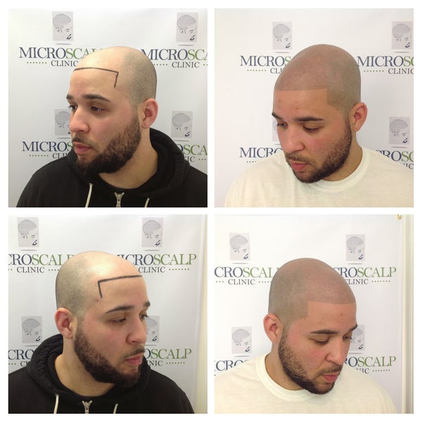 Photos At Micro Scalp Clinic Health Beauty Service In Boston
