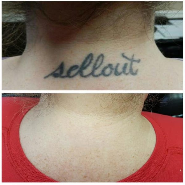 Three Laser TattooRemoval Sessions for up to 5 12 or 15 Square Inches at  LaserAway Up to 89 Off Discount Coupon Code  UpcomingEventscom