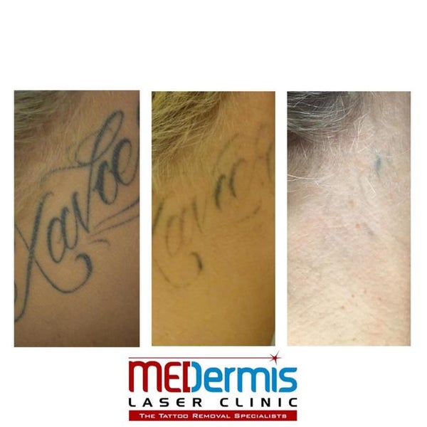 Tattoo Removal Before  After Pictures in San Antonio and Boerne TX