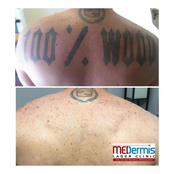 MEDermis Tattoo Removal - Zilker - Austin, TX