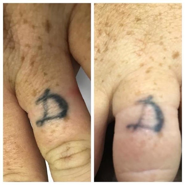Photos at Shipers Laser Tattoo Removal Center Dallas - Health & Beauty  Service