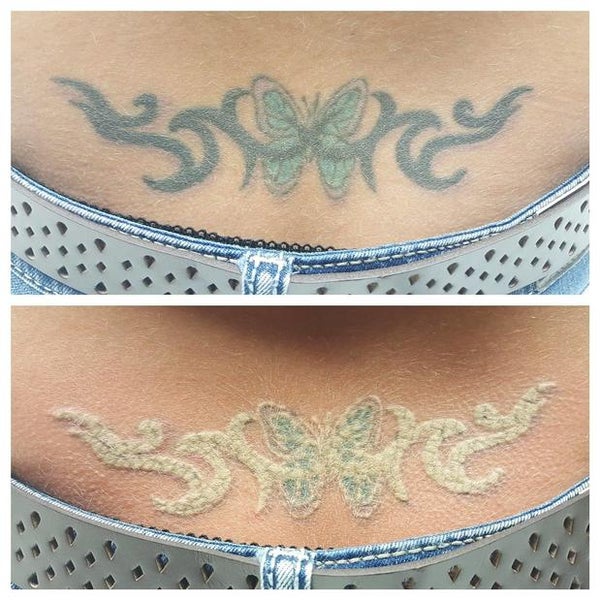 THE BEST 10 Tattoo Removal in Louisville KY  Last Updated June 2023  Yelp
