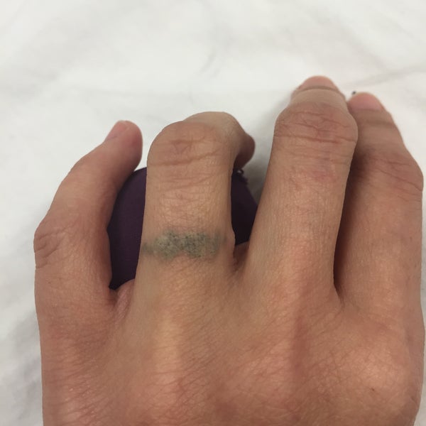 LaserAway San Diego, CA