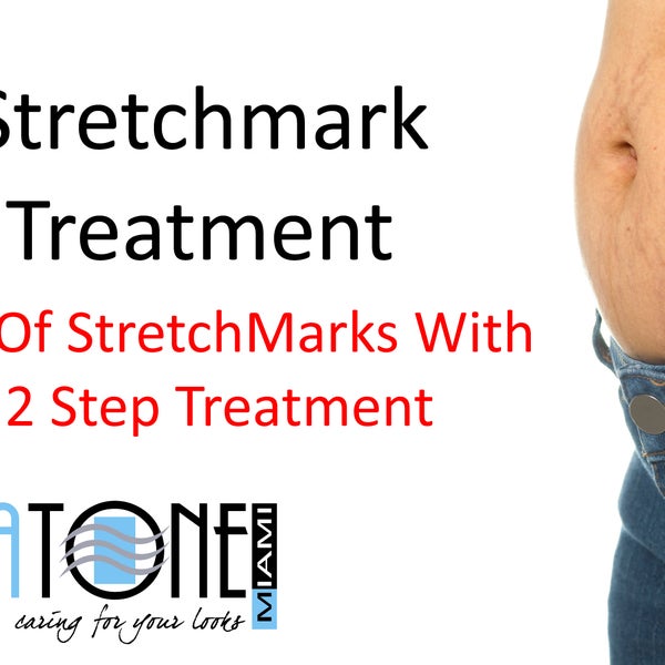 2 Step Stretch Mark treatment