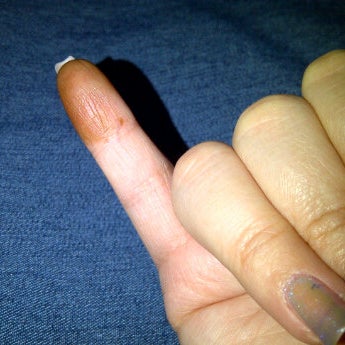 Unterm fingernagel eiter Nagelkrankheiten